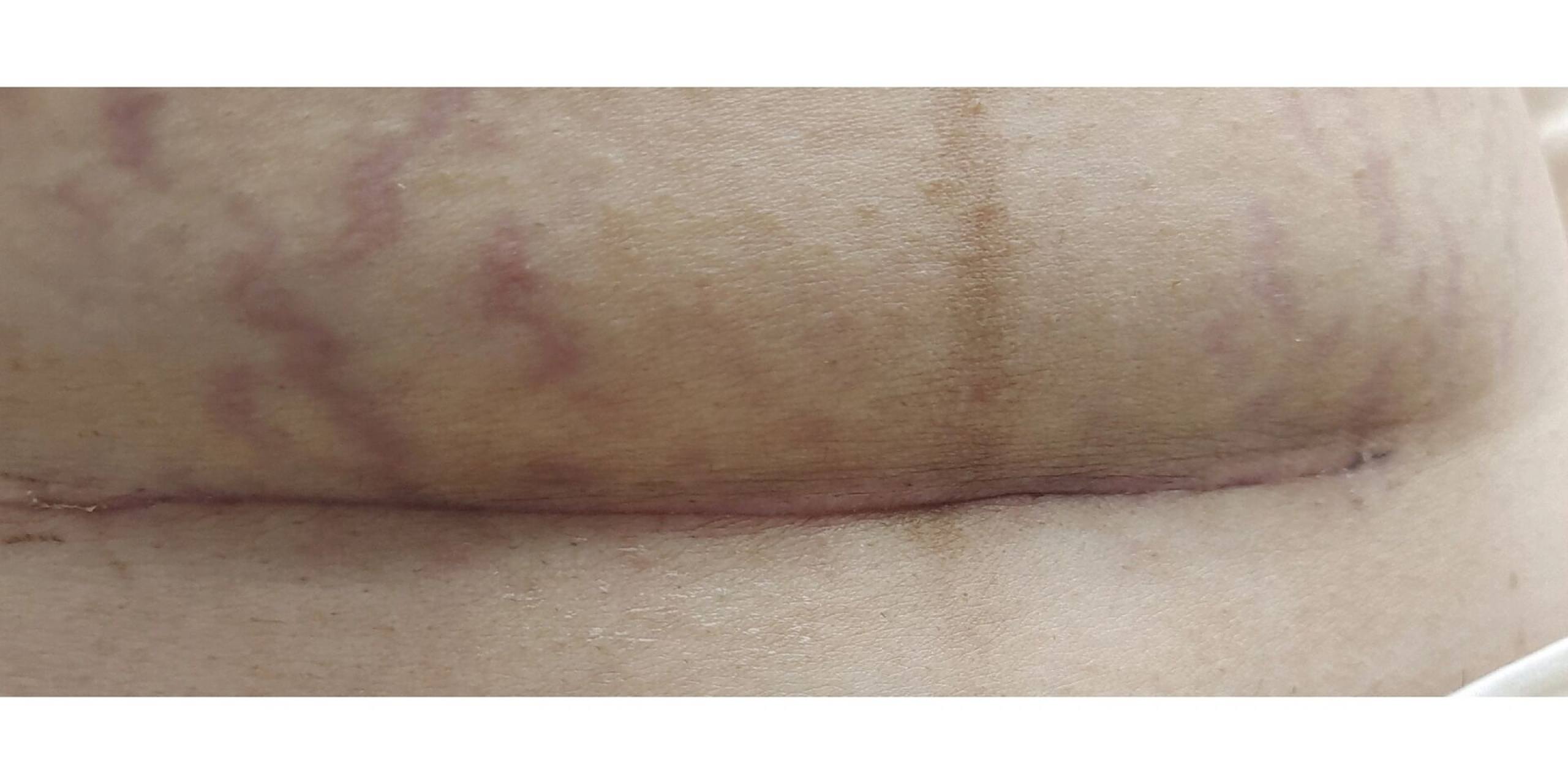 剖腹产第45天,还没掉痂,正常吗 伤口还是红红的,只有两边开始掉痂了