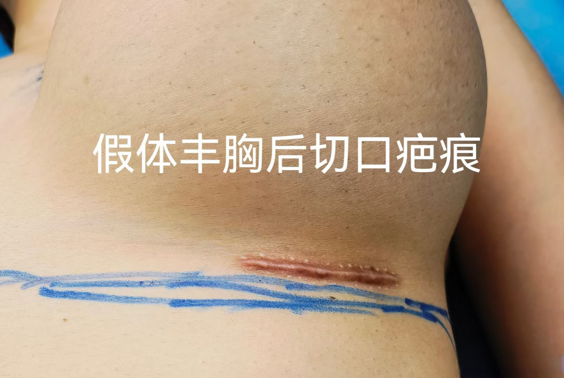 在假体丰胸术三个常见切口入路中,乳房下皱襞入路以前是不常用的,近几