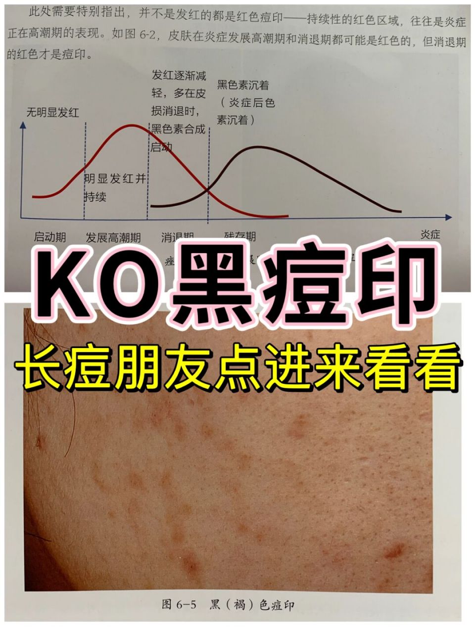 在焱症消退期,此时表现还是红痘印,同时黑色素合成程序已经开始.