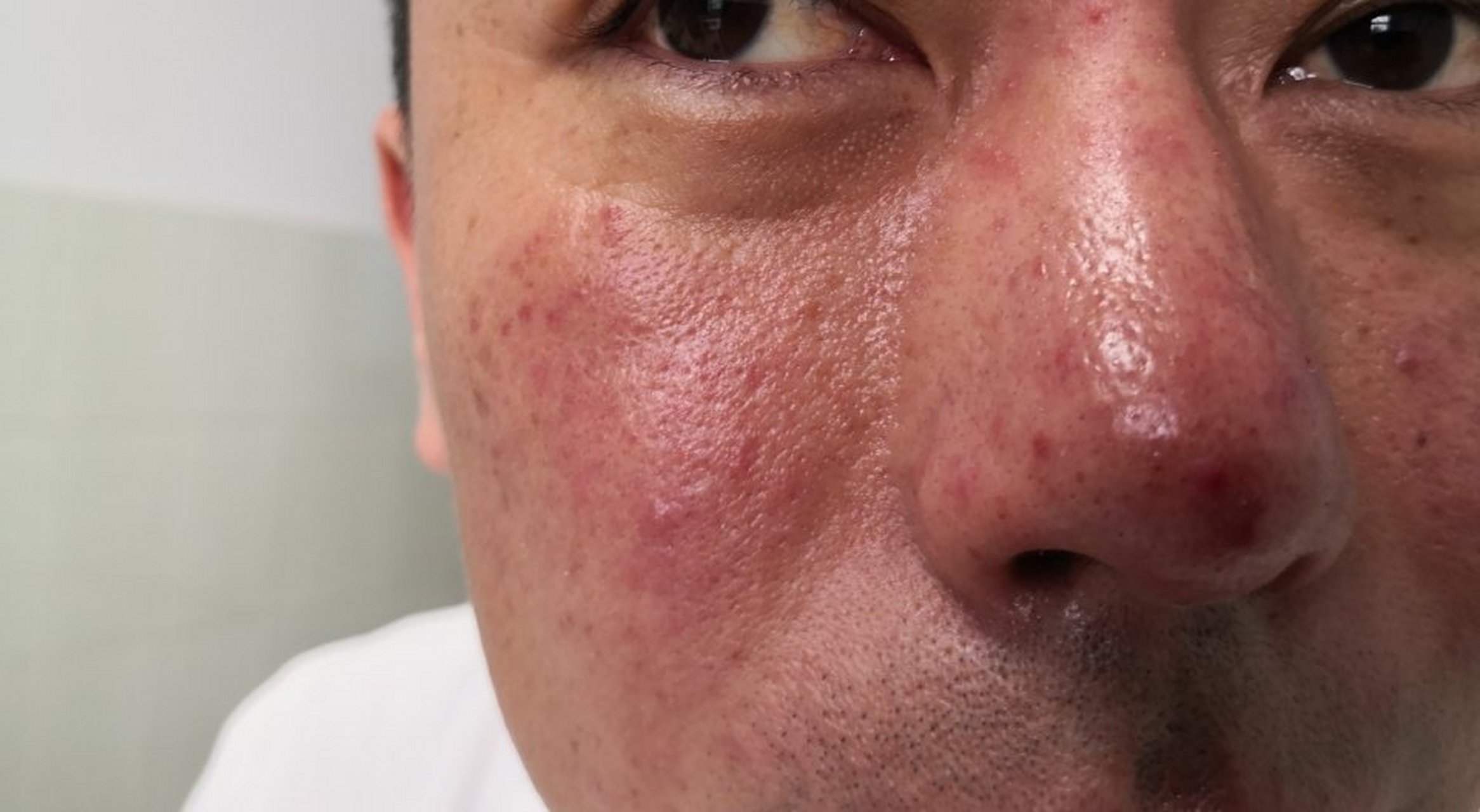 面部潮红,炎性丘疹,结节.#玫瑰痤疮##解决皮肤问题专注皮肤美容