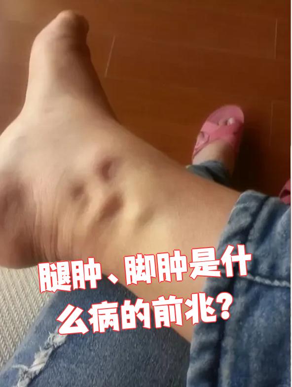 腿肿,脚肿可能是这些疾病的前兆:
