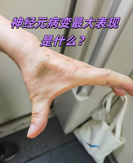 很多病人一开始会出现手部小鱼际肌萎缩,可能先发生在一边的手,慢慢