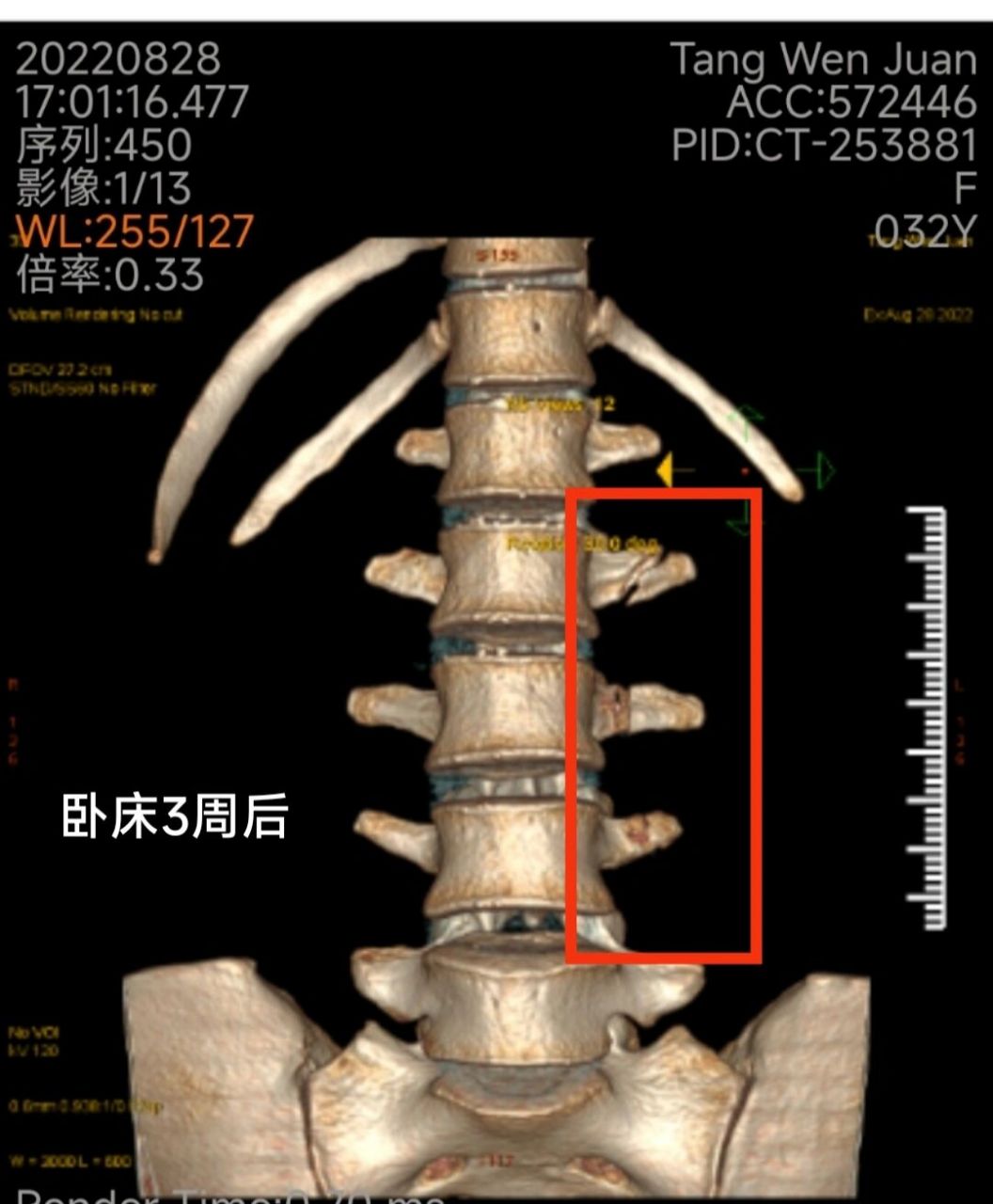 第二腰椎横突图片