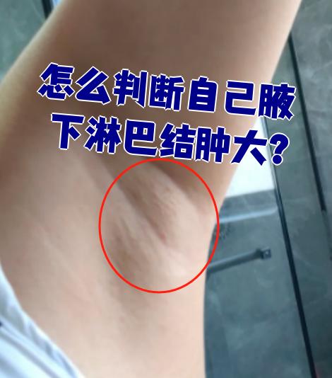 要判断自己腋下淋巴结是否肿大,可以试试这两个方法: