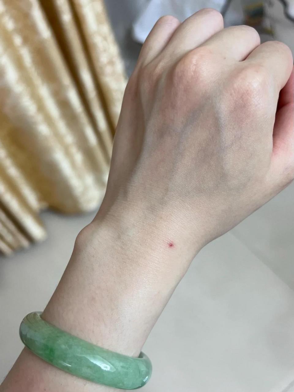 有一天左手腕上突然长了颗红点,好几年了也不消,有没有办法治好?