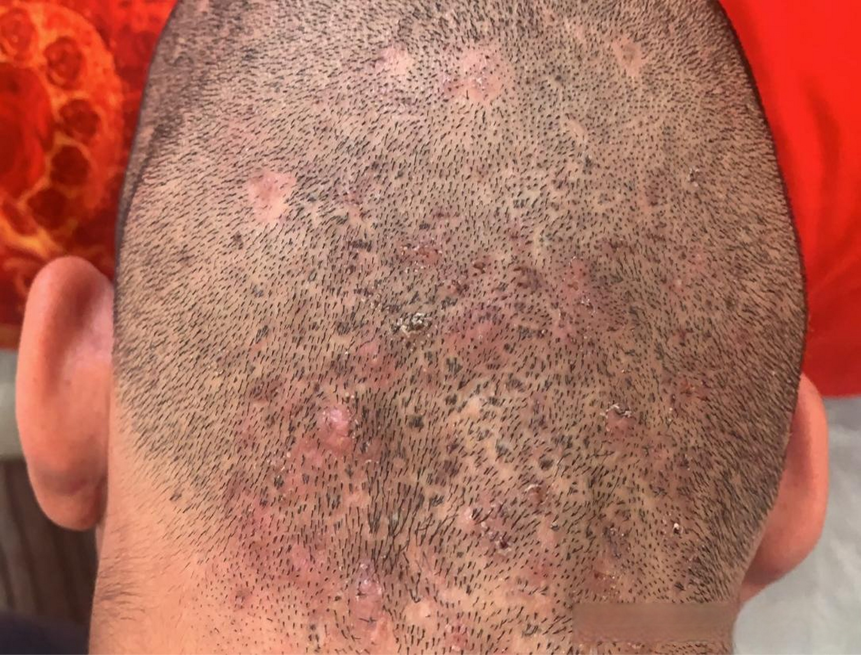 并且大鼓包下面都是连通的,这种,就叫做穿掘性毛囊炎