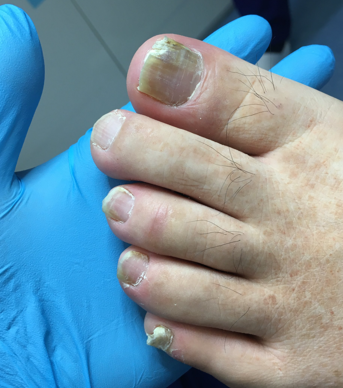 是真菌感染引起的,主要通过直接或间接接触传播