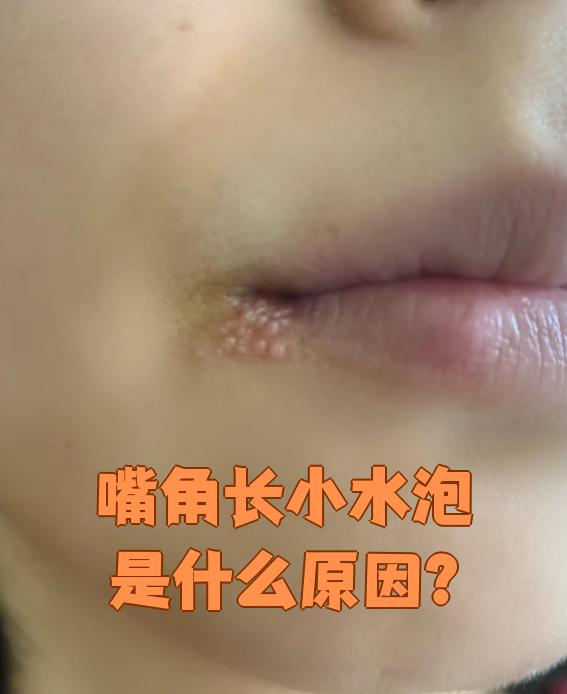 嘴角长小水泡最常见的原因有五种:蚊虫叮咬,过敏,真菌感染,细菌感染