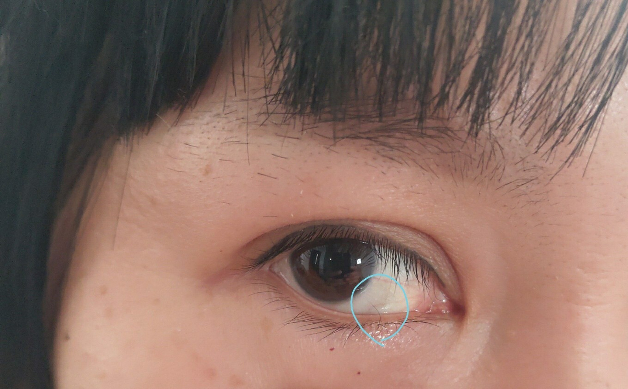 下眼睑长了一根倒睫 别小看这一根细细弱弱的小睫毛,一整天开眼睛的