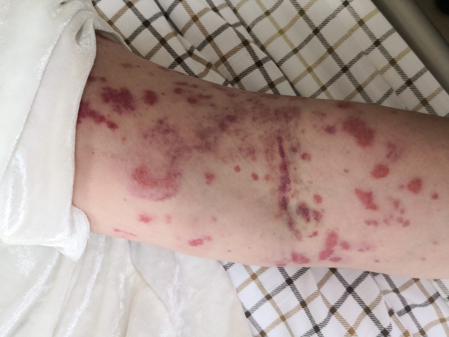 过敏性紫癜症状.严重的iga血管炎.#解决皮肤问题专注皮肤美容##血管炎