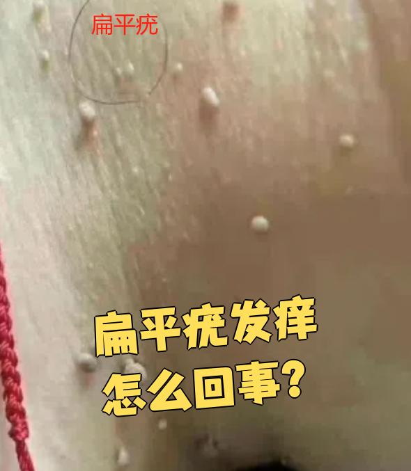 为什么会得扁平疣 为什么会得扁平疣