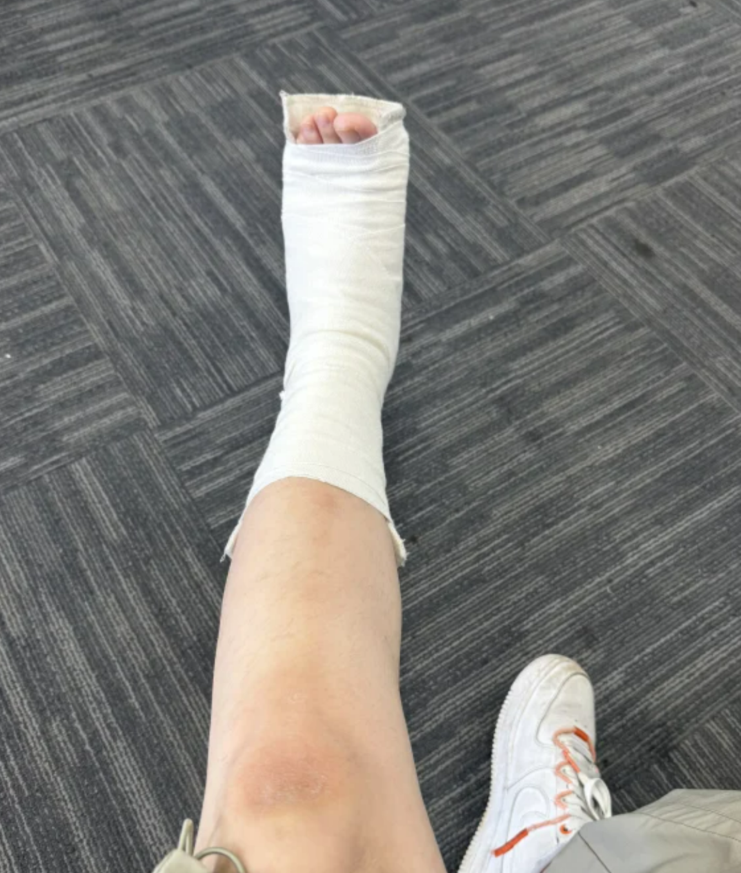 如果是轻度撕裂,说明损伤不严重,对韧带稳定性影响较小