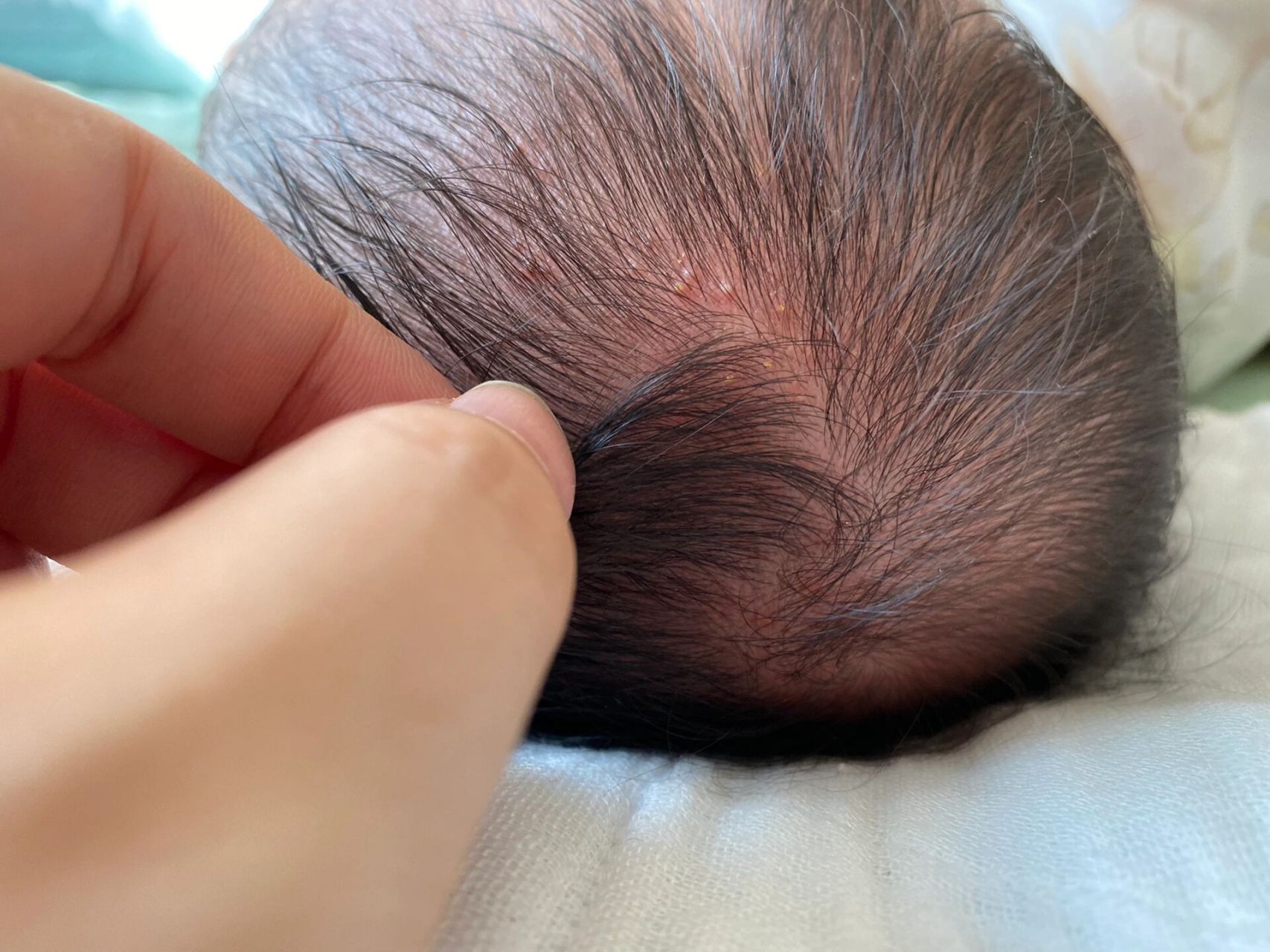 儿科主任教最短时间解决新生儿脓疱疹 崽子还没满月,这头上就突然长了