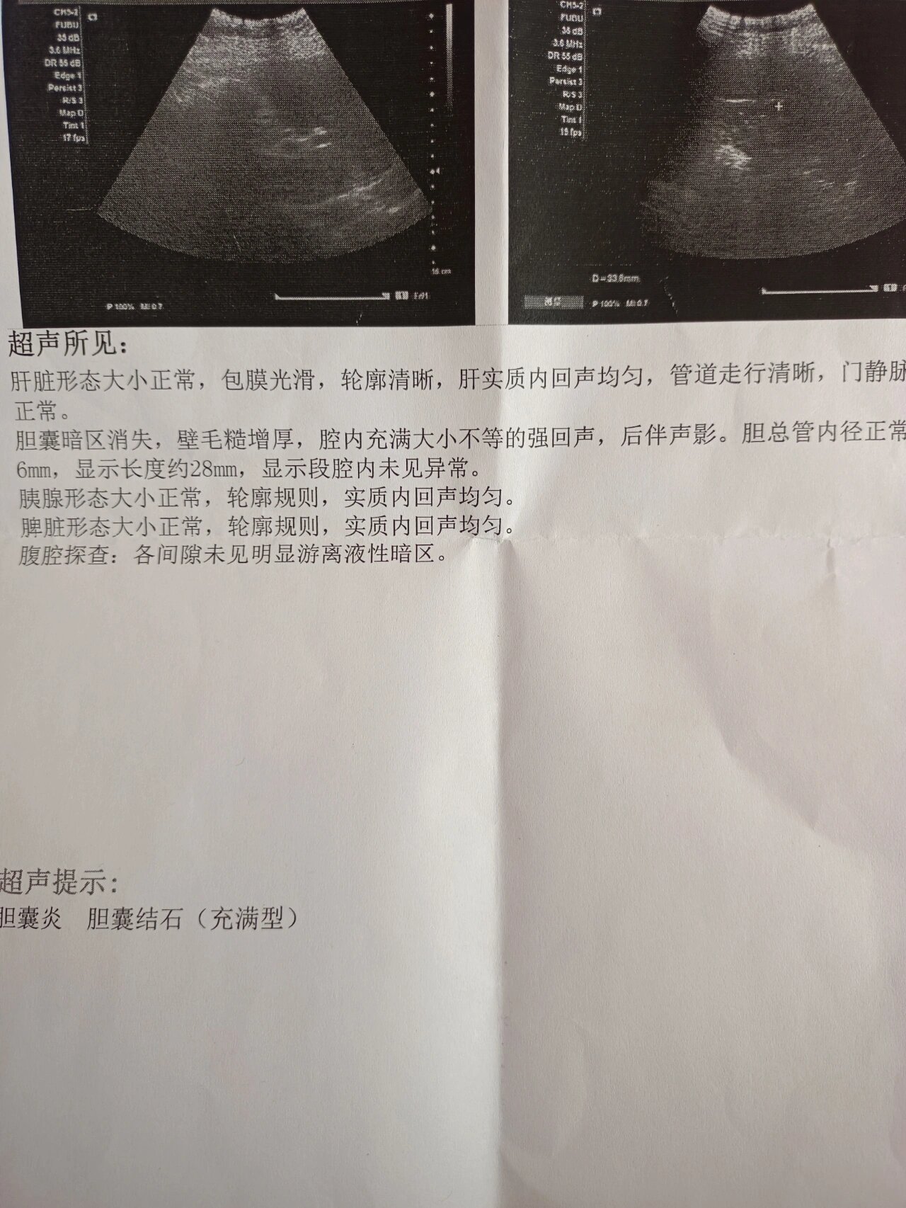 胆结石,充满型无症状胆结石