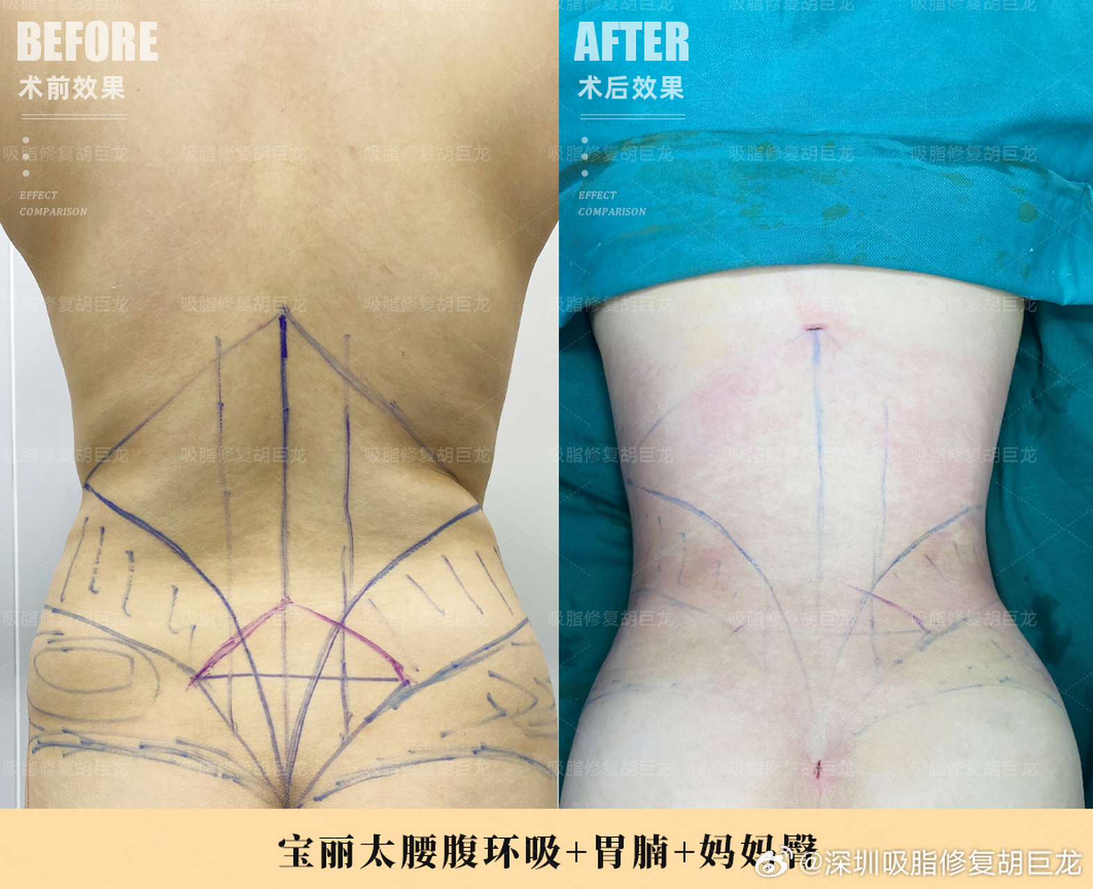 【宝妈腰腹环吸 胃腩 妈妈臀术后即刻案例对比】