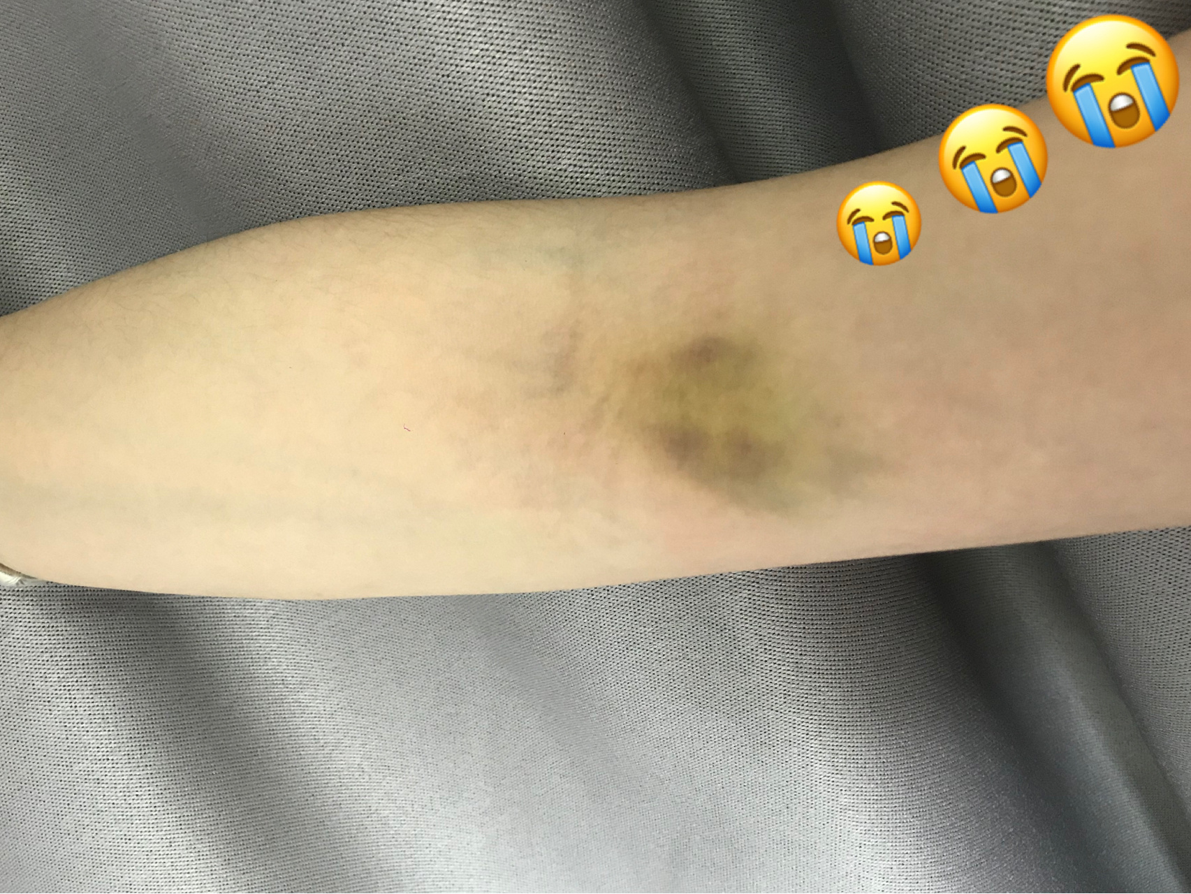 抽血五天依旧淤青 单位职业健康查体之抽血01 去年抽血抽一送一今年