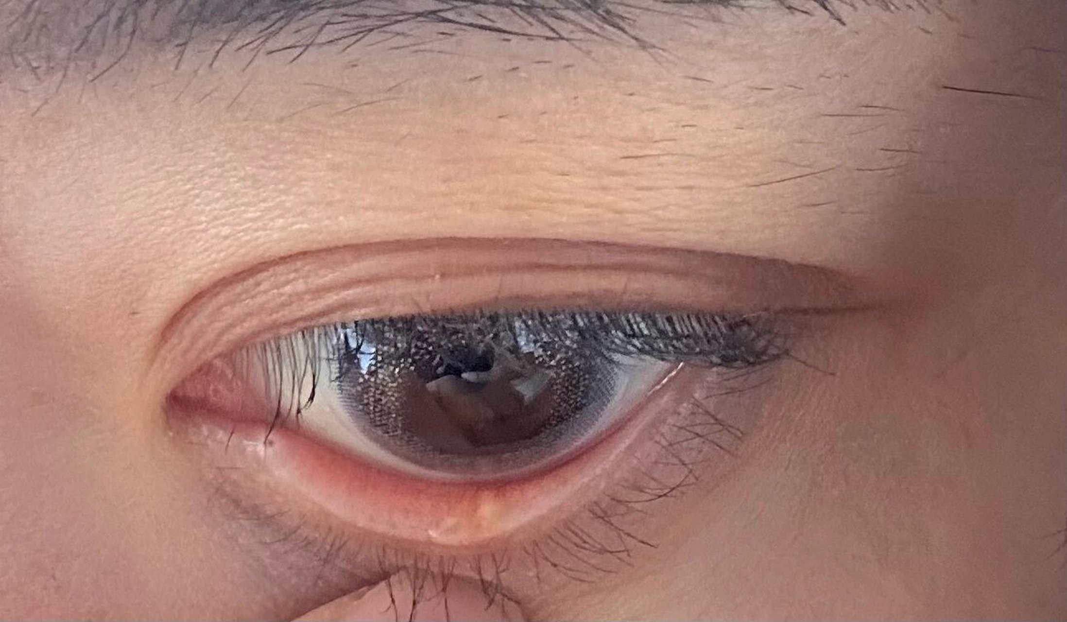 下眼睑长了一颗透明凸起 下眼睑这个透明的凸起是什么呀?没有任何不适