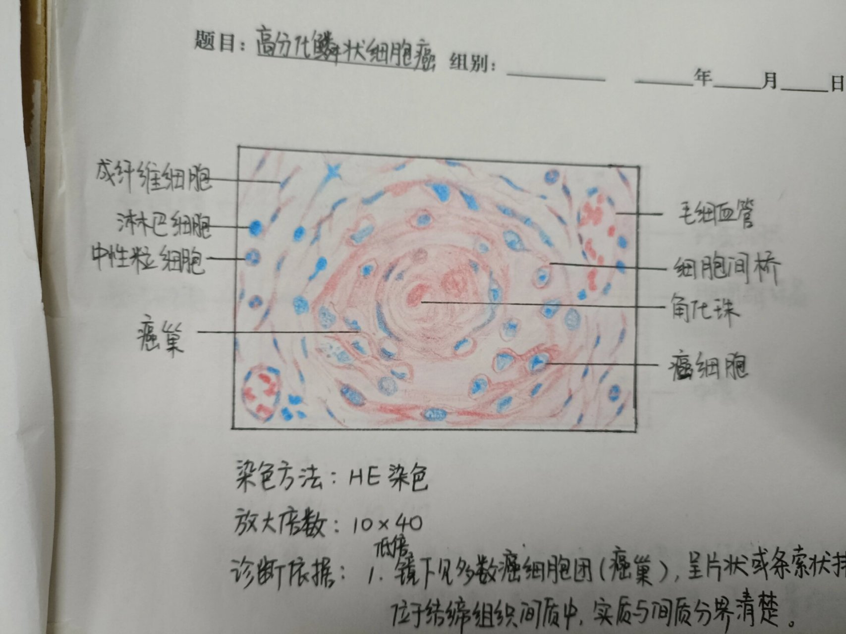 医学生绘图高分化鳞状细胞癌 红蓝铅笔绘图高分化鳞状细胞癌