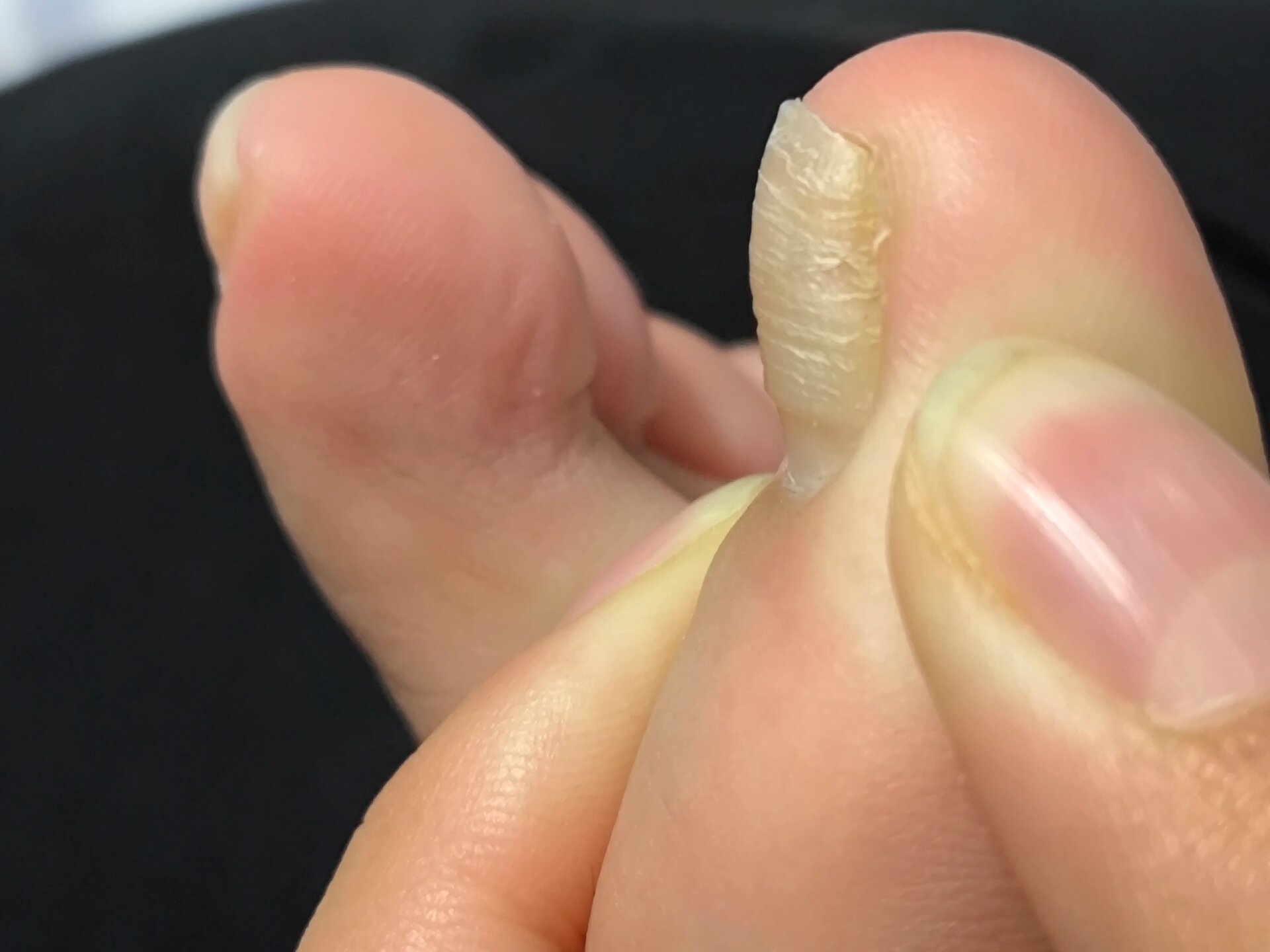 大脚趾甲分层是怎么回事      大脚指甲分层了 其他的都没有 已经有一