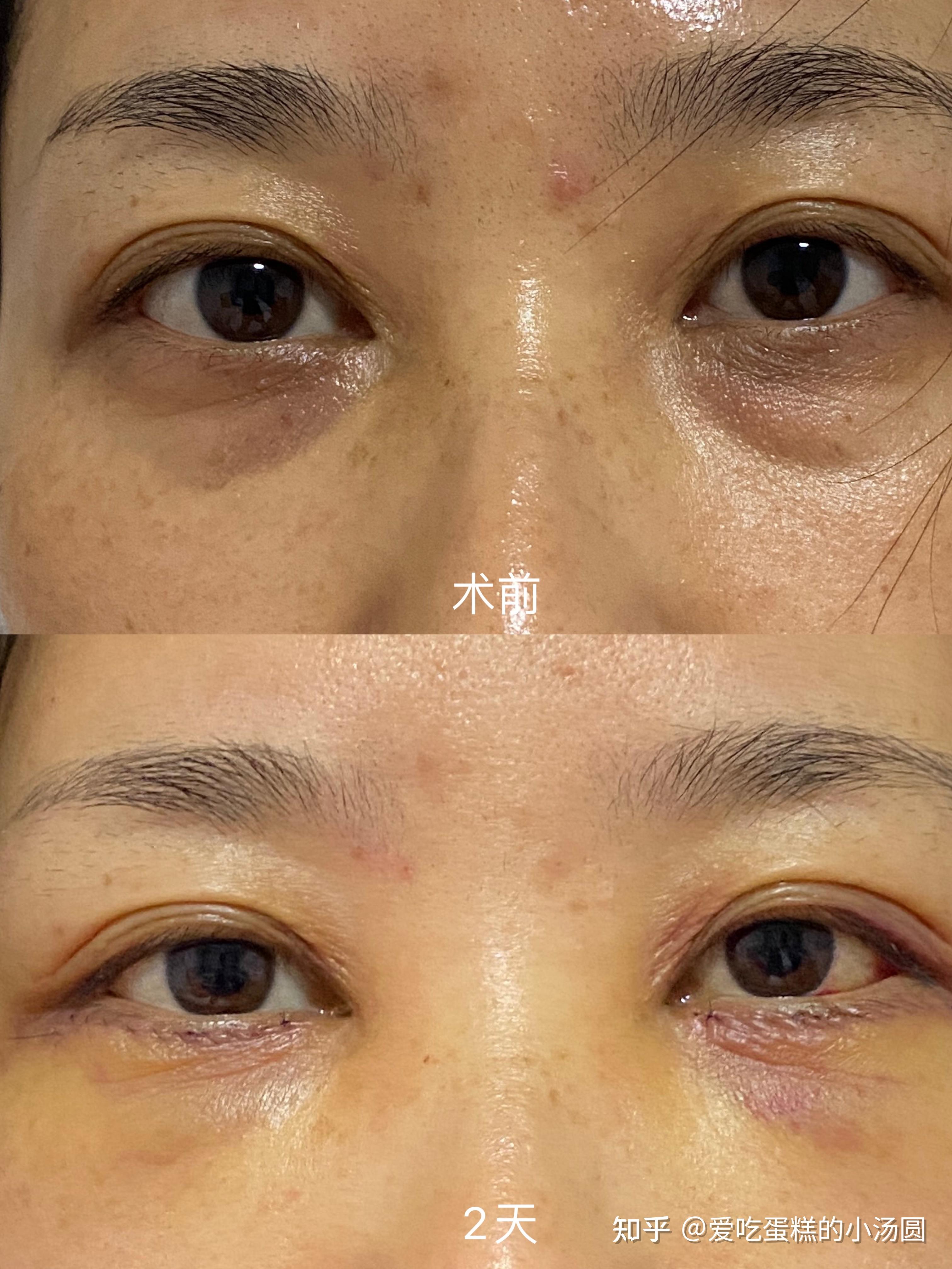 外切眼袋眶隔释放恢复期记录