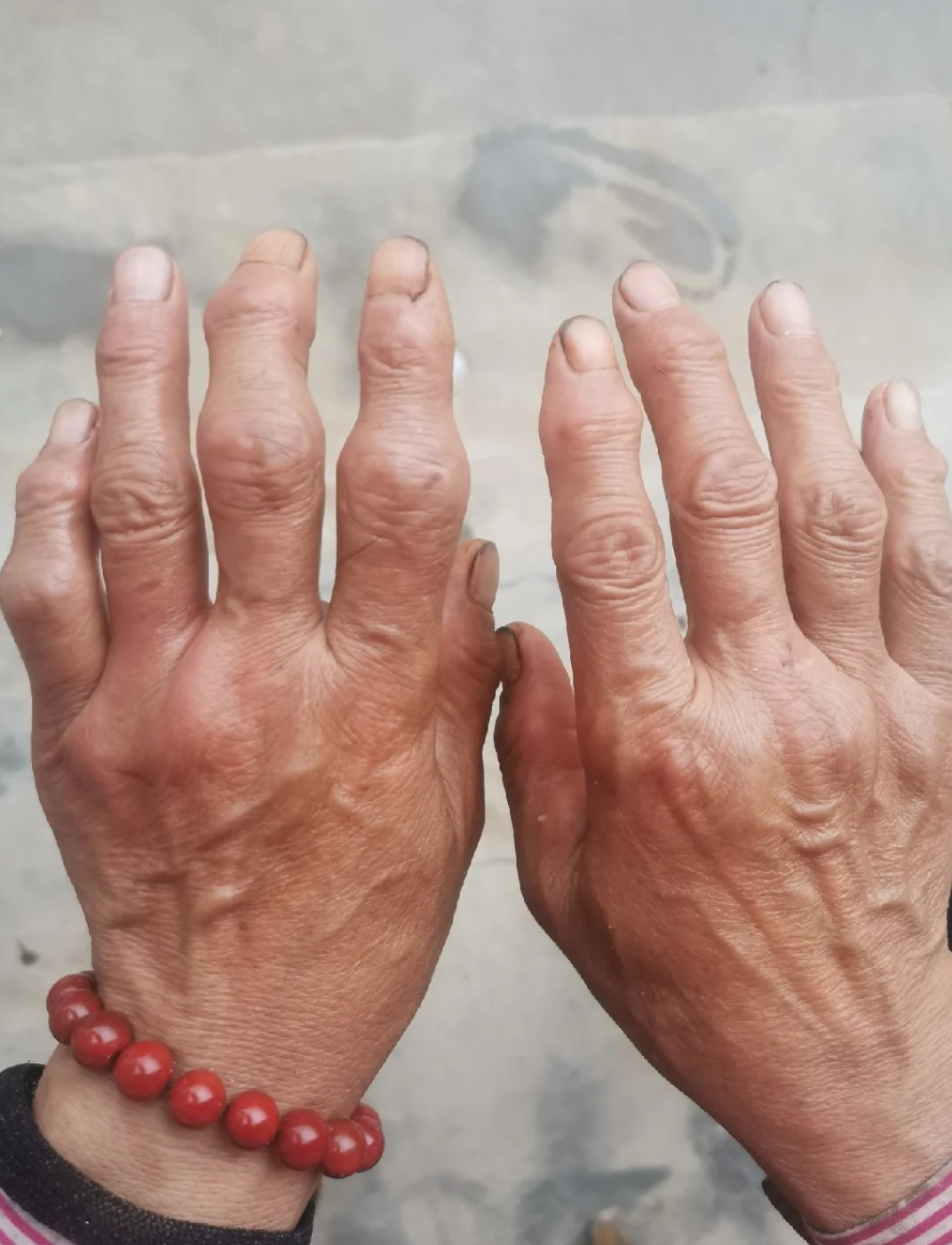 肿胀疼痛发作时要尽量让关节休息,避免过度用力或频繁活动手指