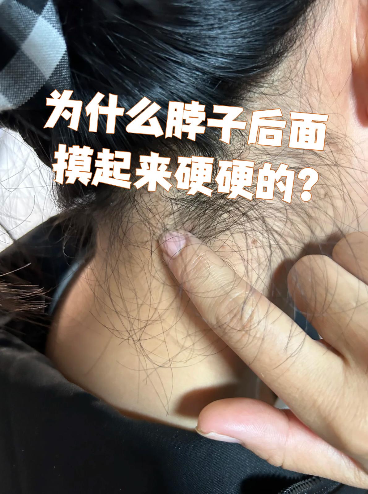 脖子后面摸起来硬硬的,最常见的原因是肌肉紧张