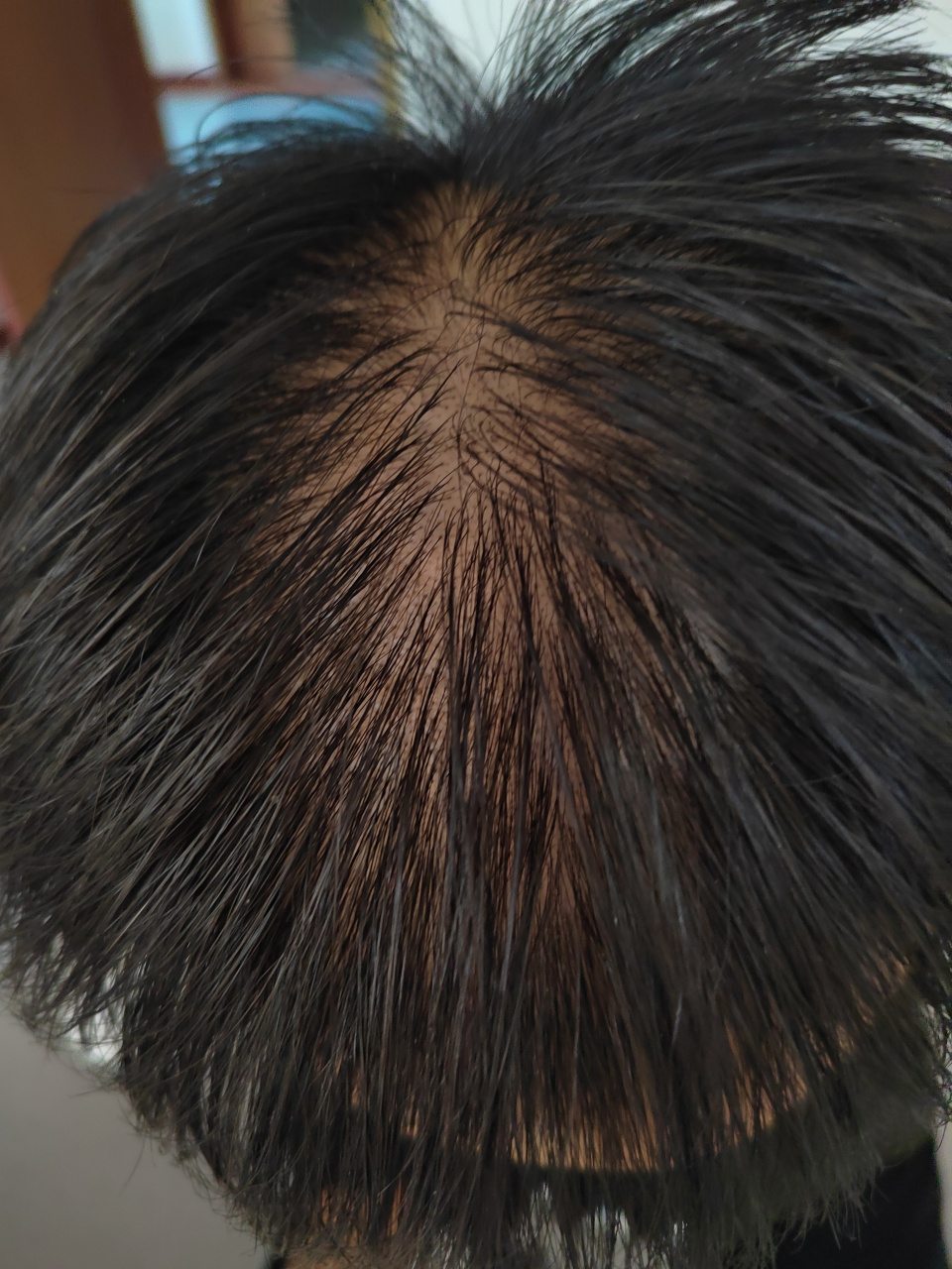 脱发# 治疗半年左右后,脱发数量变少,头皮油腻减轻.