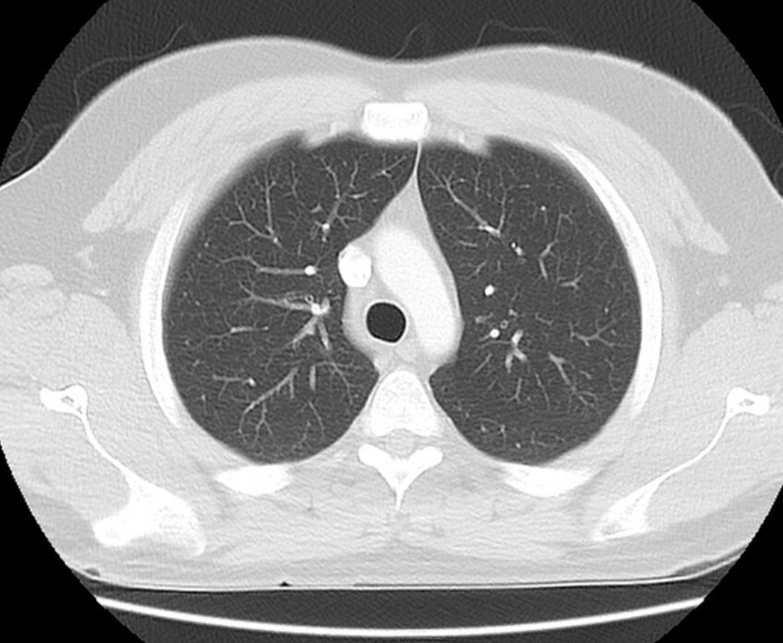 肺癌对应的ct影像-1 很多朋友问肺ct怎么看,以及肺癌影像有什么特点