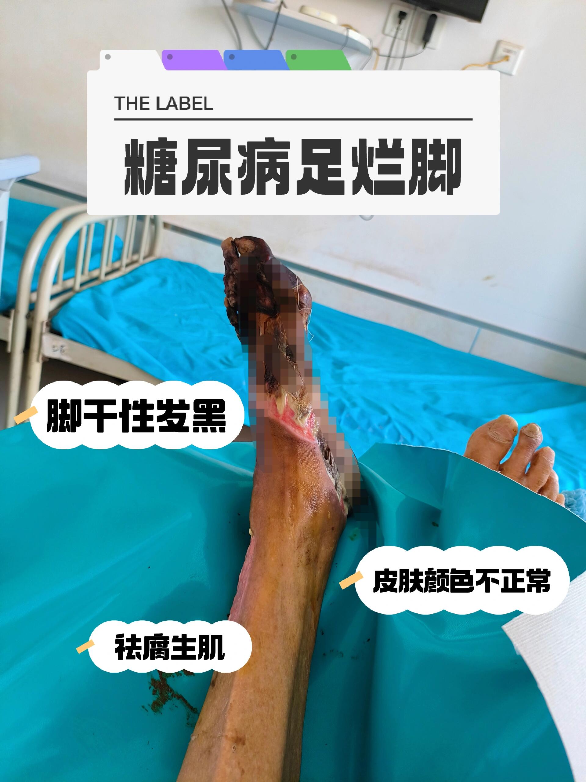 老爷爷发黑流脓流水 老爷爷的糖尿病足