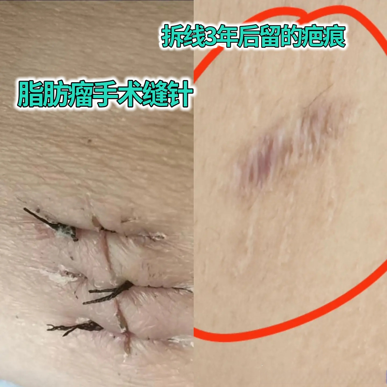 同样是手术切除脂肪瘤,普通手术切缝方式和精细手术切缝方式下疤痕