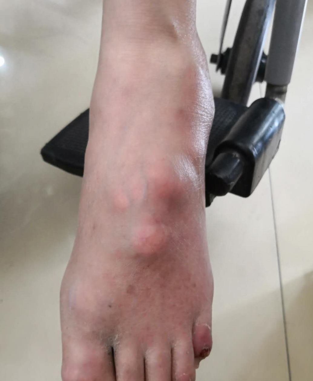 痛风发作时,症状通常出现在关节和周围软组织