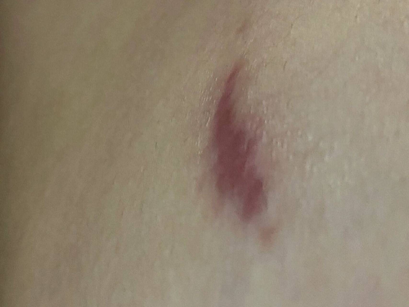 疤痕增生,乳腺纤维瘤手术后 姐妹们,能给我看一下,我这是疤痕增生了吗