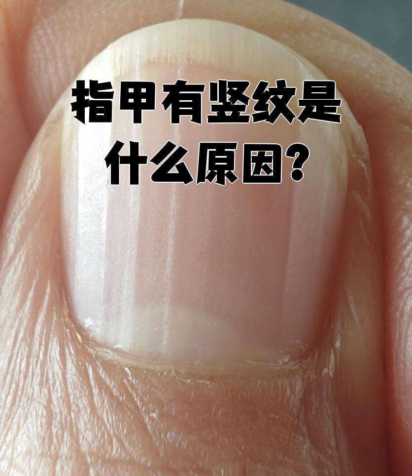 女性指甲有竖纹要警惕为什么在线