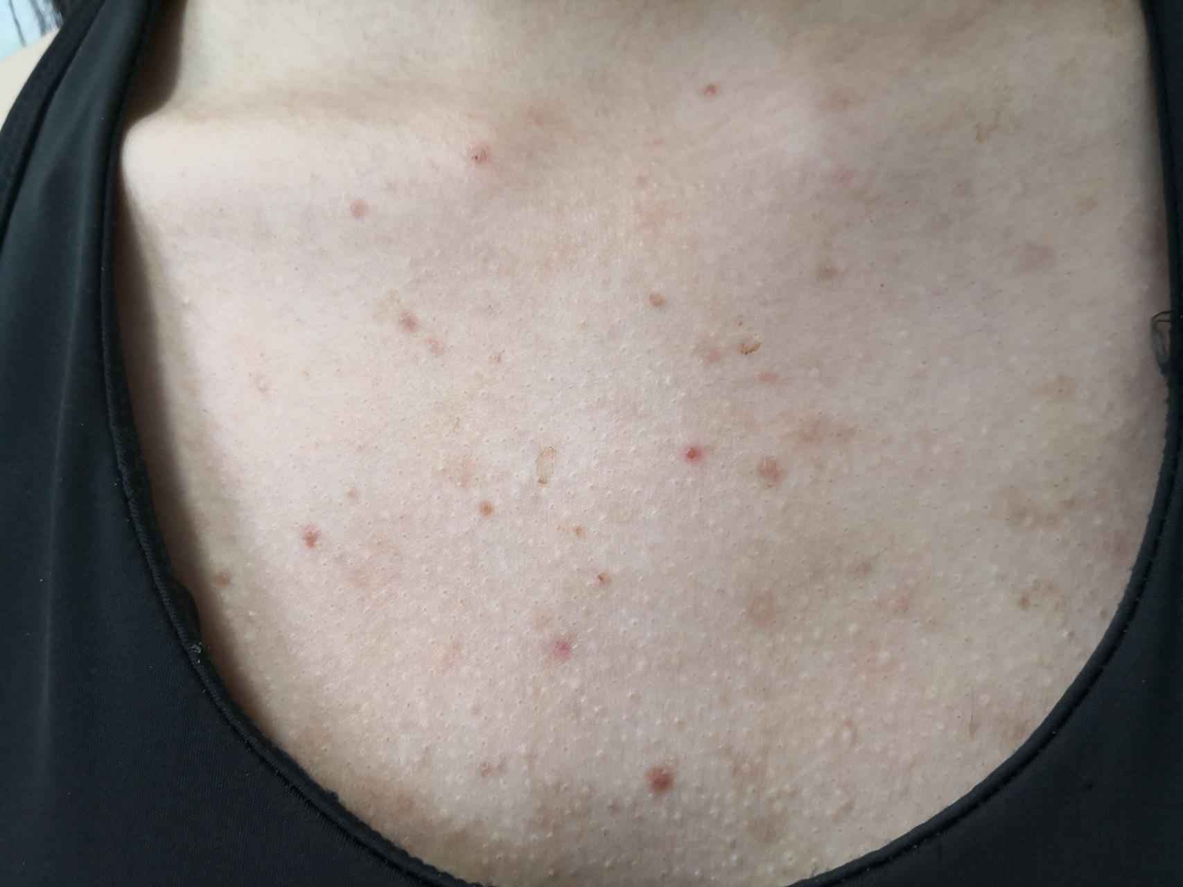 躯干部位毛囊炎症状,经过一段时间的治疗后效果不错,症状明显减轻.