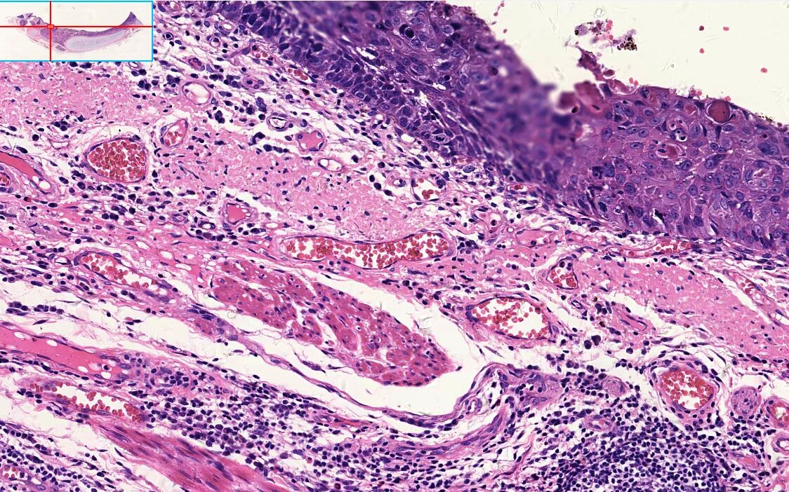 病理学切片,鳞状上皮化生