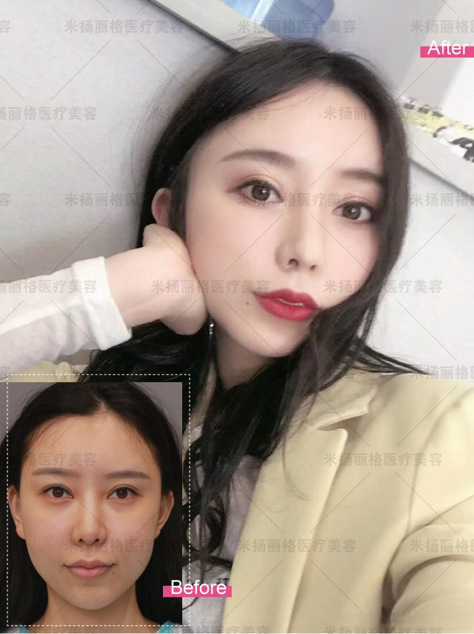 面部中轴线,三点一线,是面部美学的一个标准,眼,鼻,颏三点一线,面部