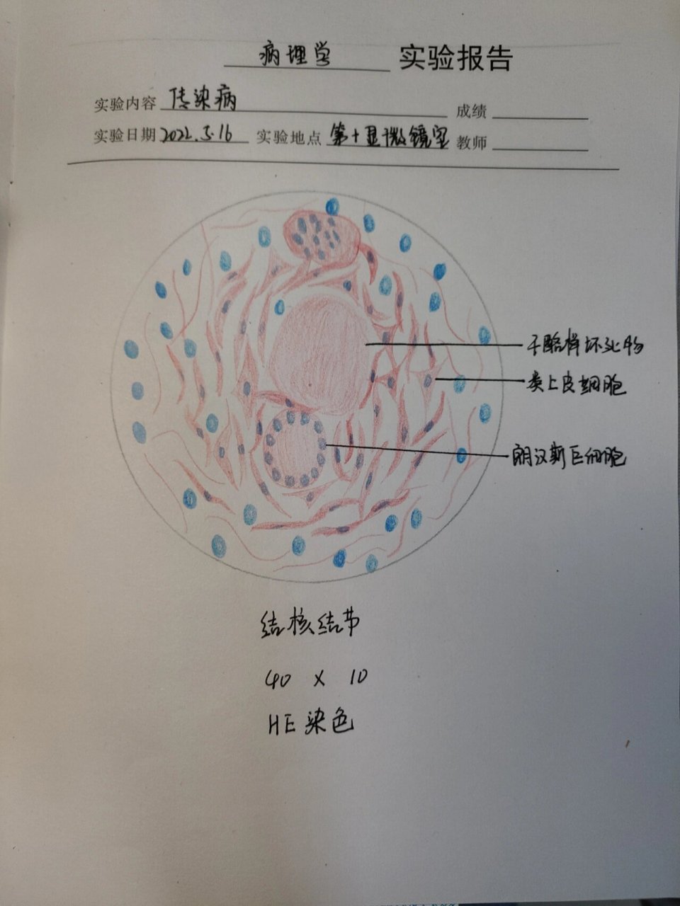 结核结节 红蓝铅笔手绘图 病理学