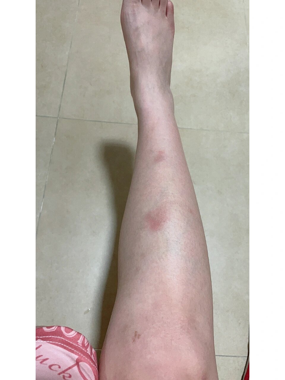 结节性红斑