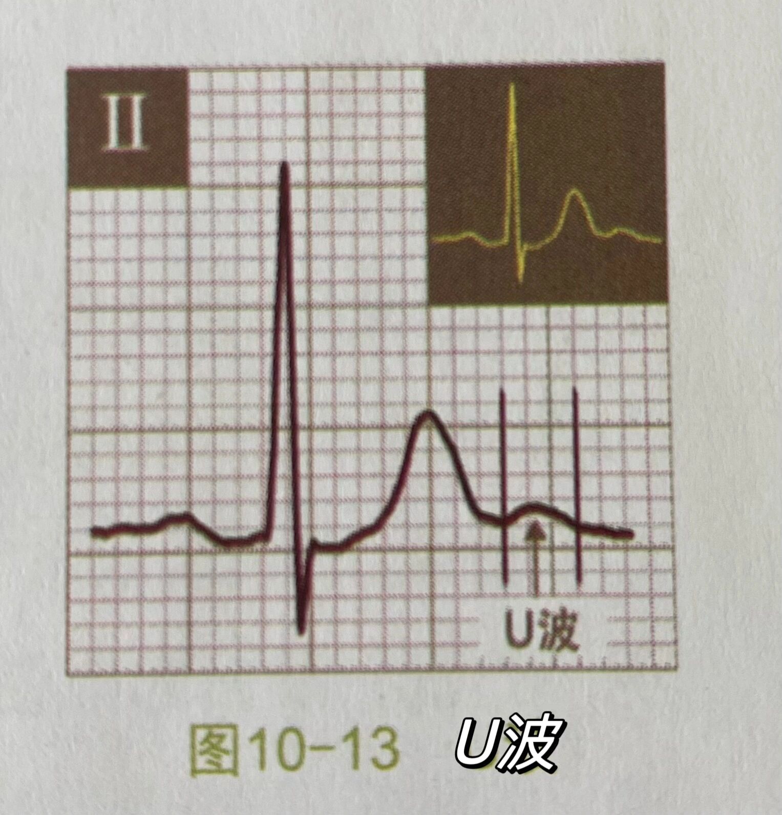 学习心电图之正常心电图波形