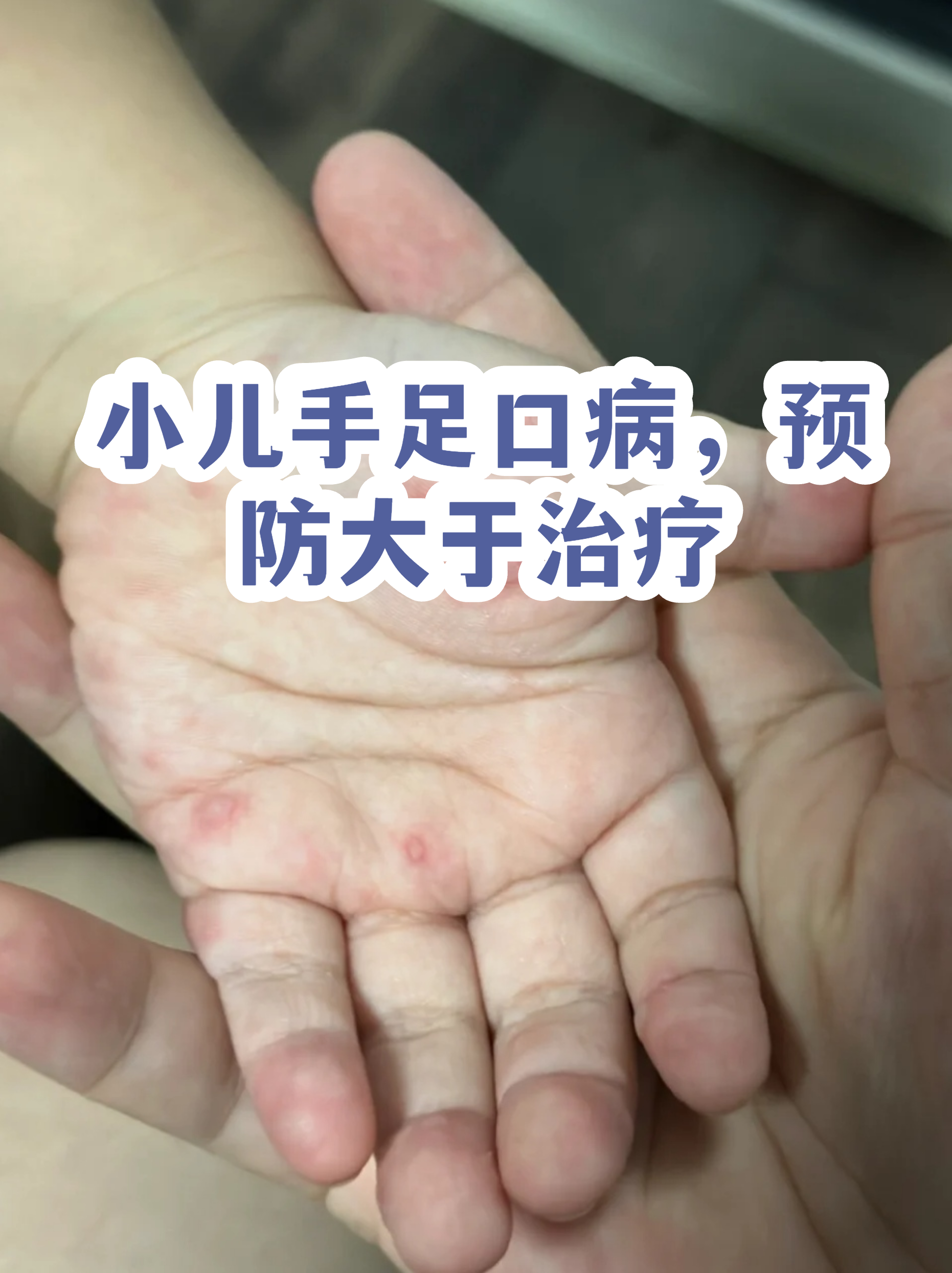 手机口病的症状 手机口病的症状