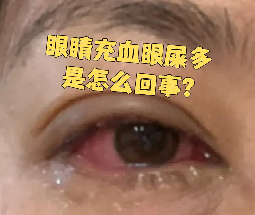 为什么眼睛有眼屎 为什么眼睛有眼屎