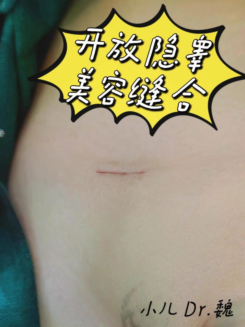手术日常|隐睾手术方式如何选择? 严格把握开刀和微创的手术指征.