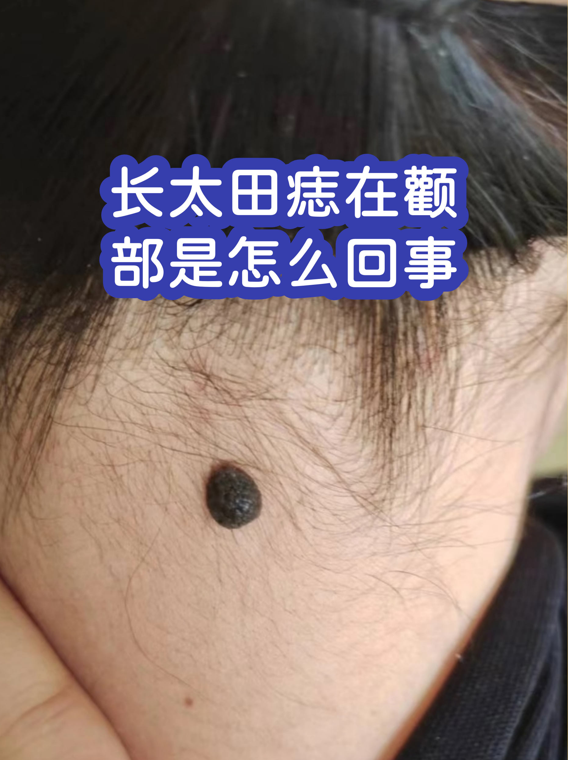 长太田痣在颧部是怎么回事