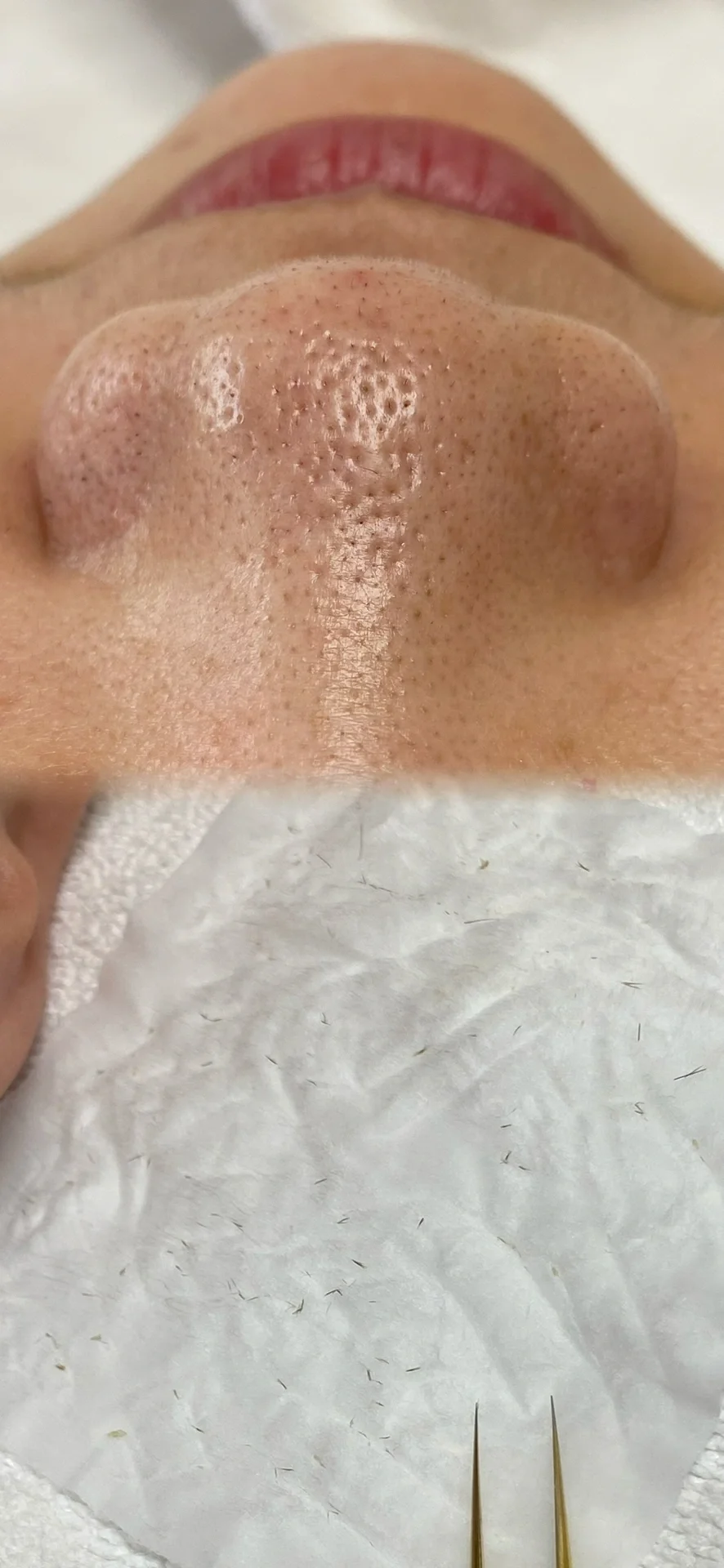 鼻翼两侧的黑毛毛——毳毛