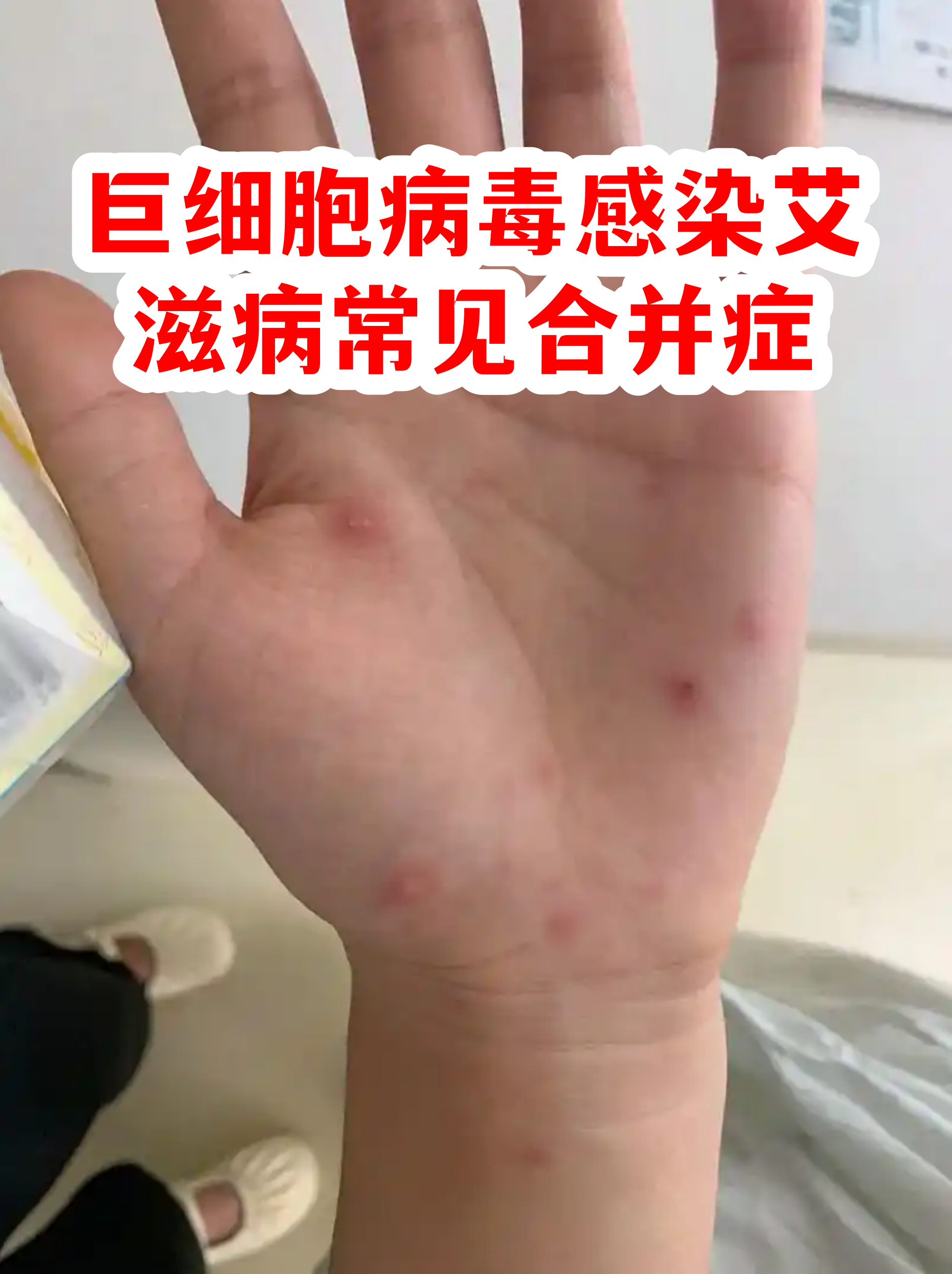  女性巨细胞病毒是什么引起的(女性巨细胞病毒是什么引起的原因)