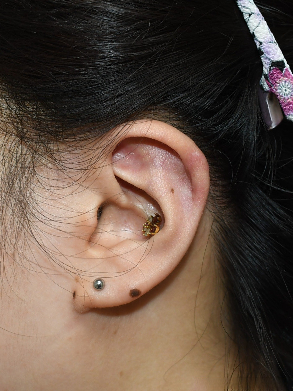 耳朵上长了5年的疤痕疙瘩,外院打过针后复发反而更大了.