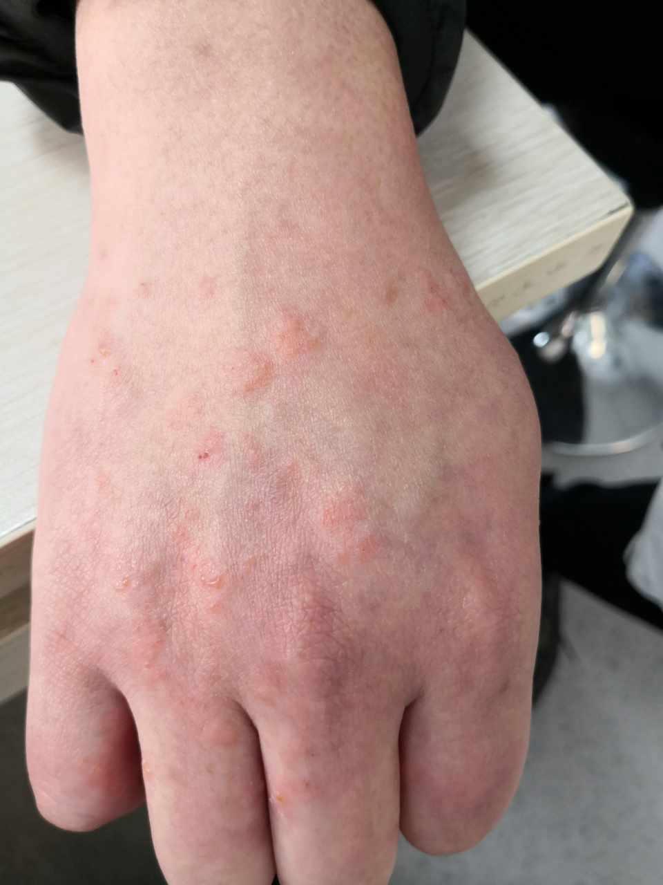 手背的过敏症状.#湿疹