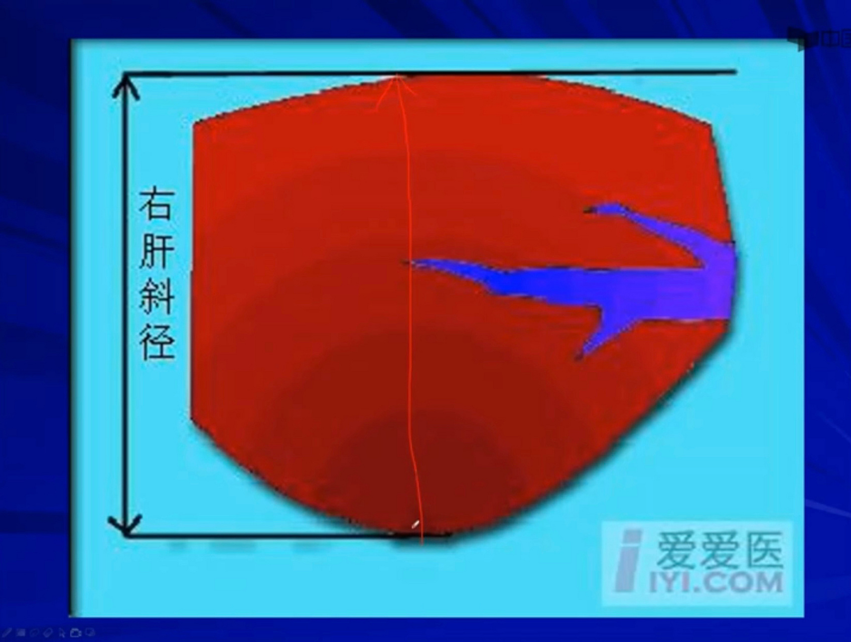 超声学习 7915肝脏扫查基础之超声解剖6015 99第二肝门斜