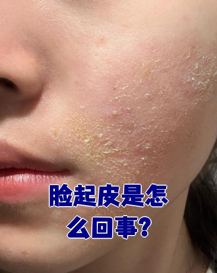 脸上起皮最常见的原因是皮肤角质层受损,再加上水分不足