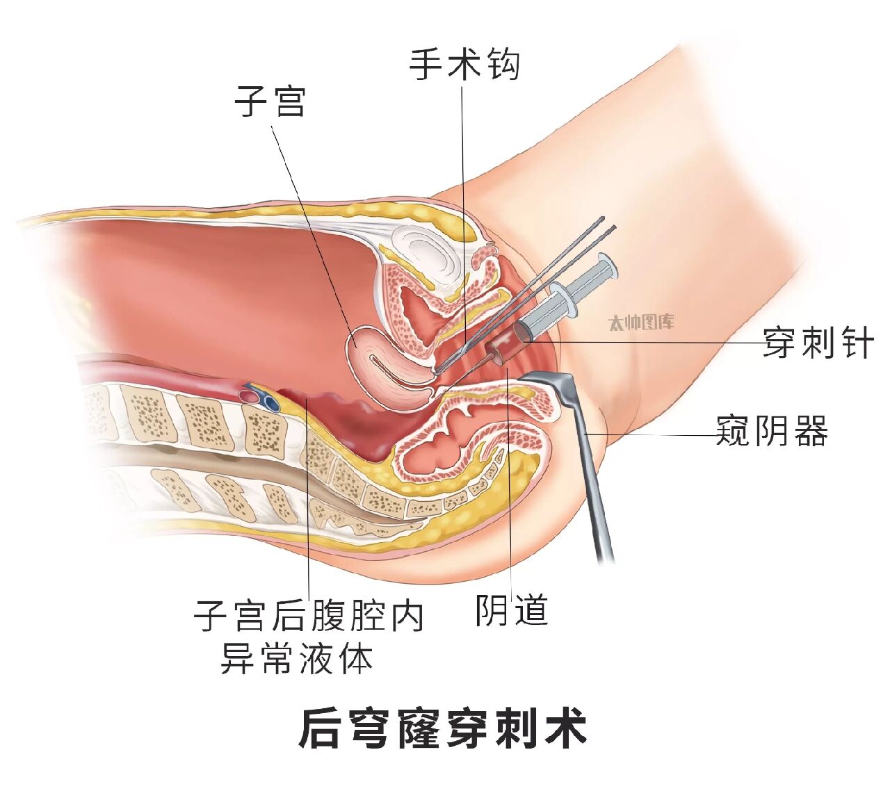 异位妊娠部位图片图片